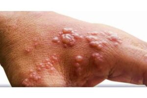 Eight-year-old in Andhra found with suspected Monkeypox symptoms