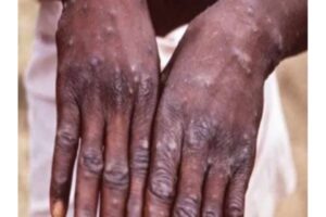 First Monkeypox case reported in India